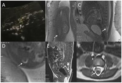 Fetal magnetic resonance imaging in the diagnosis of spinal cord neural tube defects: A prospective study